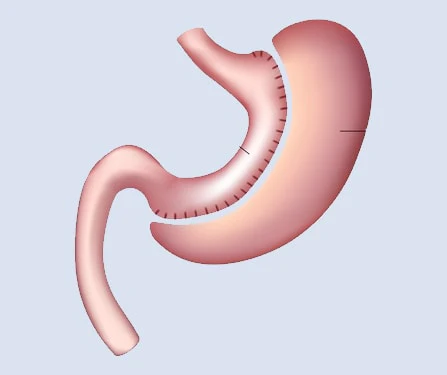 https://clinoraclinic.ghayatltd.com/wp-content/uploads/2026/06/materials/gastric- sleeve/sleeve.webp
